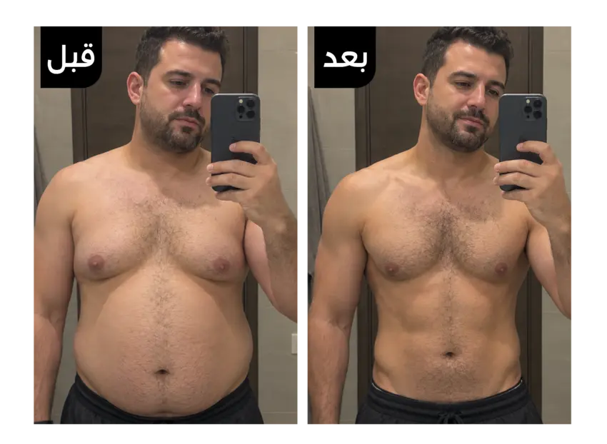 نتيجة قبل وبعد استخدام ترافيس جيل لنسف دهون البطن والأرداف 3